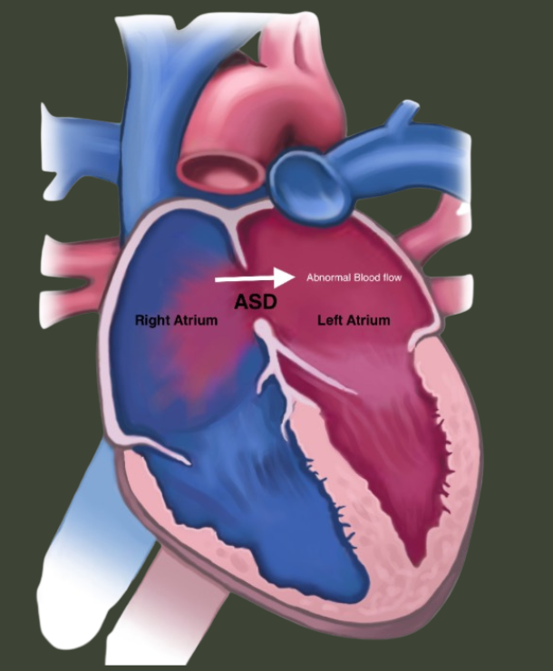 asd atrial septal defect