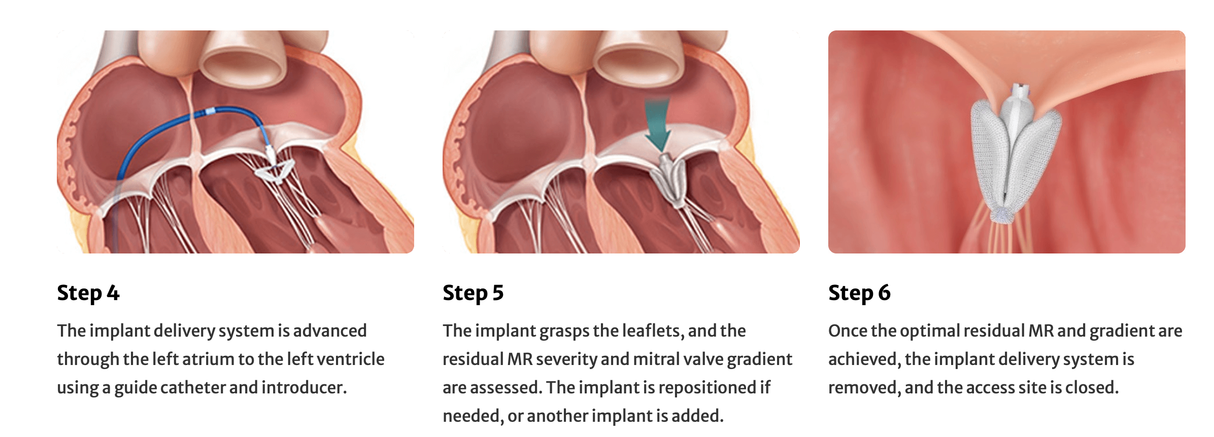 TEER heart murmur heart valve disease