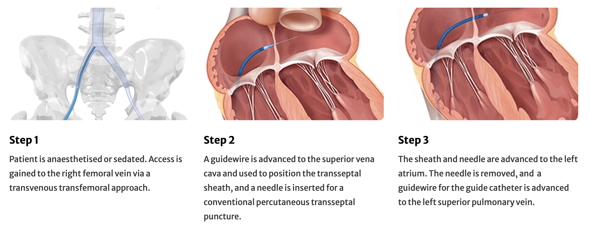 teer mitral regurgitation mitraclip