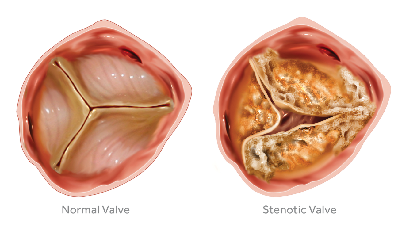 aortic stenosis severe tavi