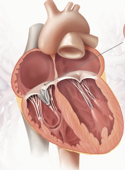 tricuspid teer cardiologist cardiology