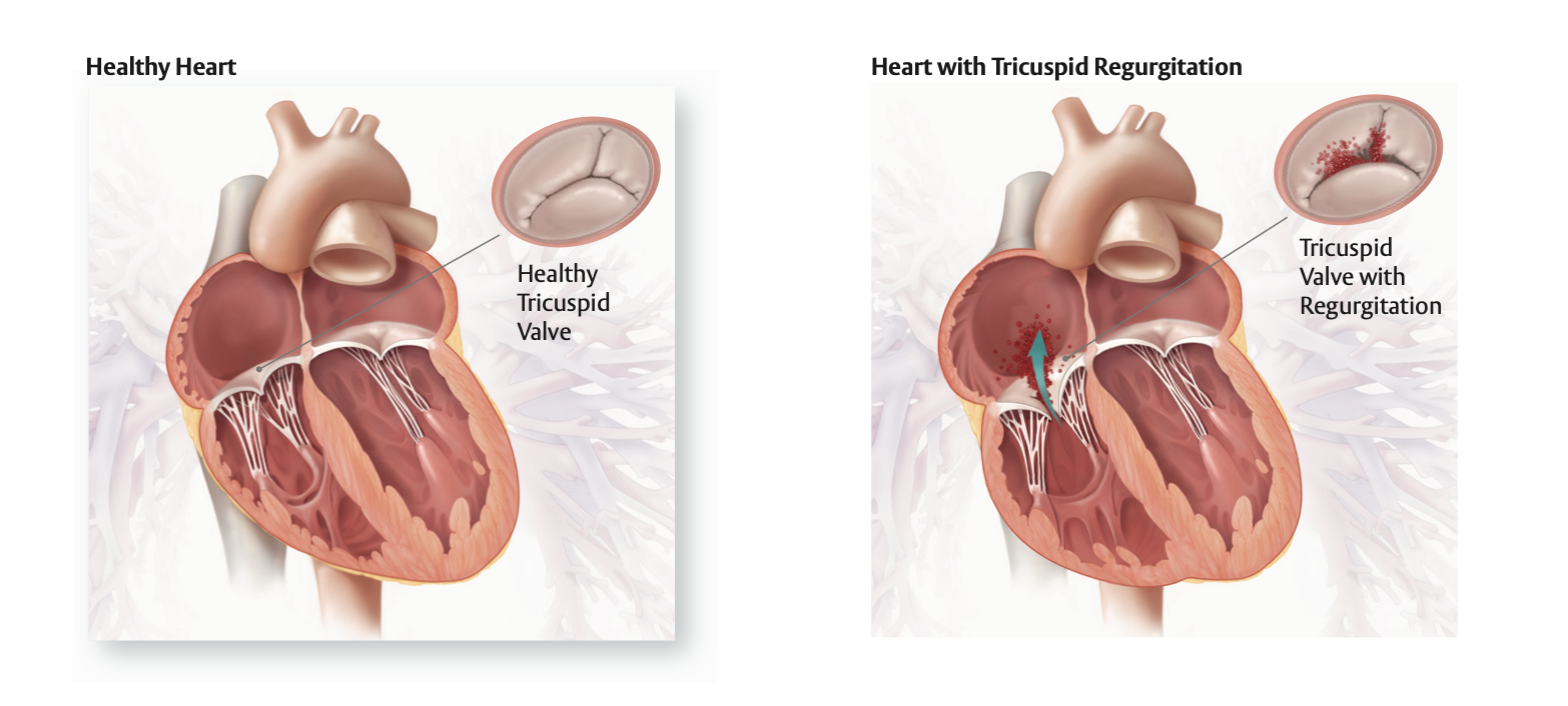 teer tricuspid regurgitation procedure minimally invasive