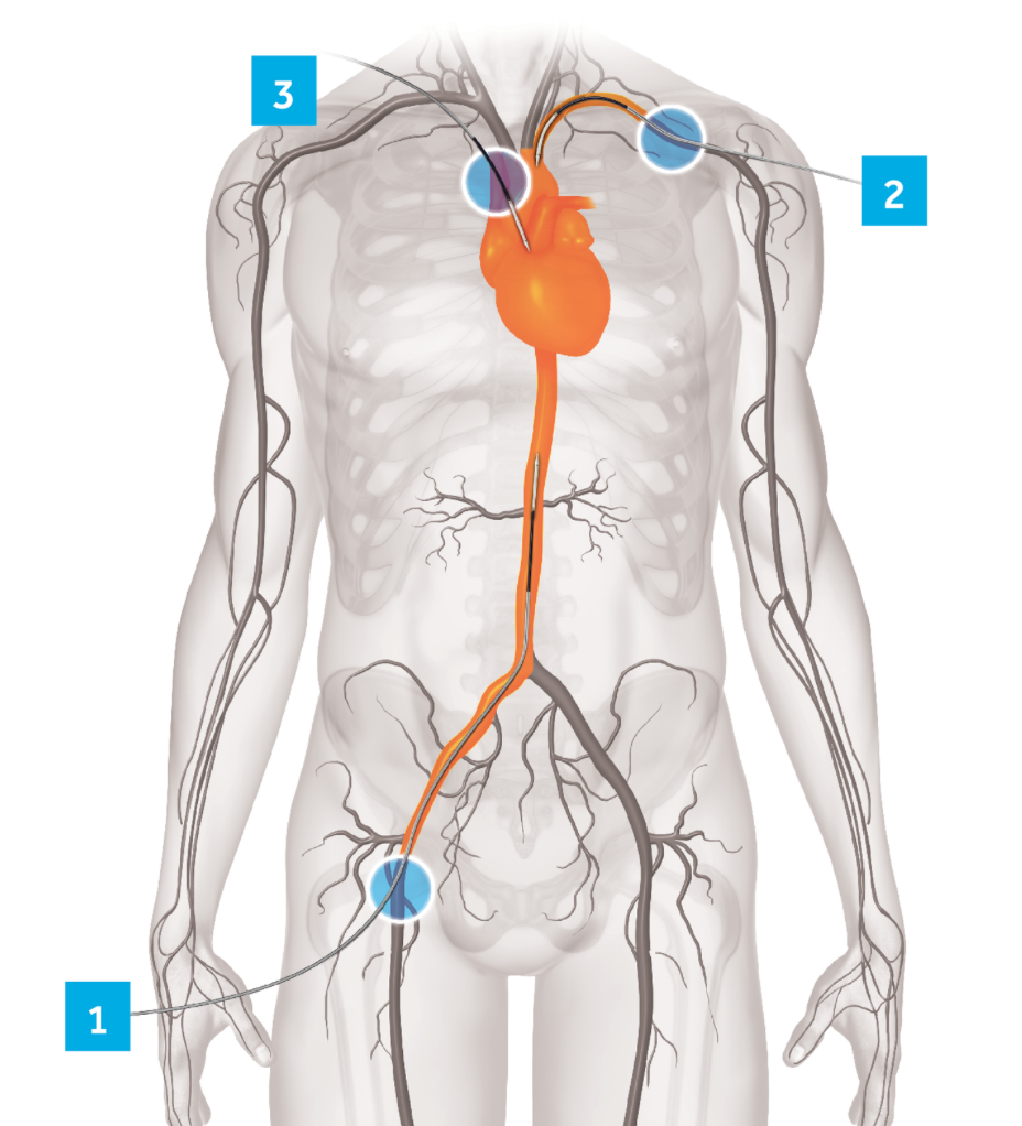 tavi tavr aortic stenosis