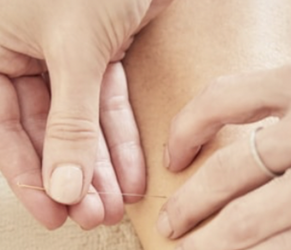 Een persoon krijgt een acupunctuursessie met naalden op de huid.