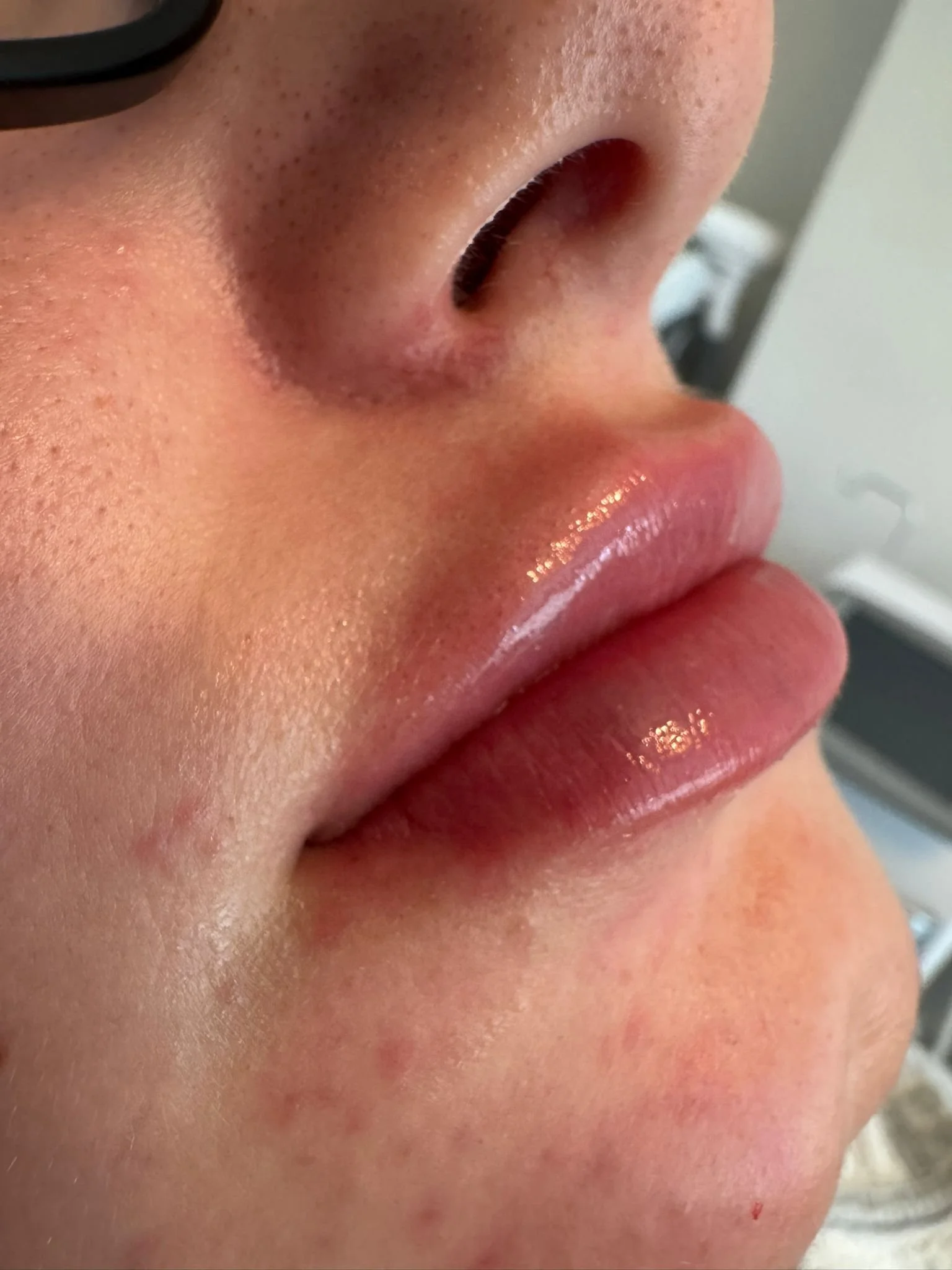 Close-up of a person's nose and lips, showing skin with small freckles and red blemishes.