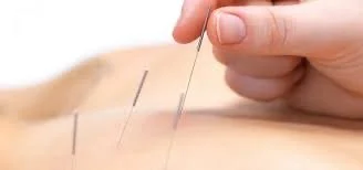 Close-up of a hand holding two acupuncture needles above a person's skin.