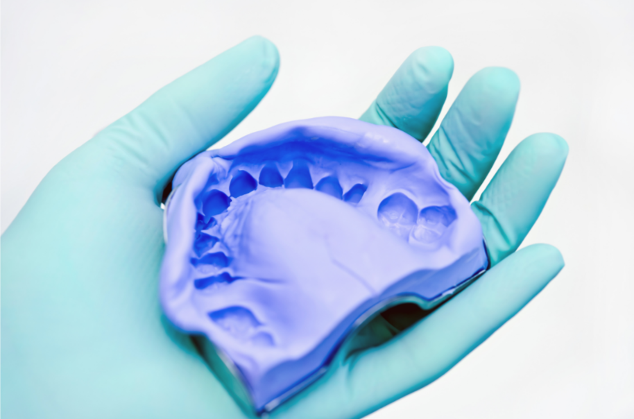 A hand wearing a blue medical glove holding a blue dental mold of the upper teeth.