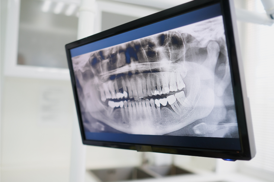 Dental X-ray displayed on a computer monitor showing teeth and jaw structure