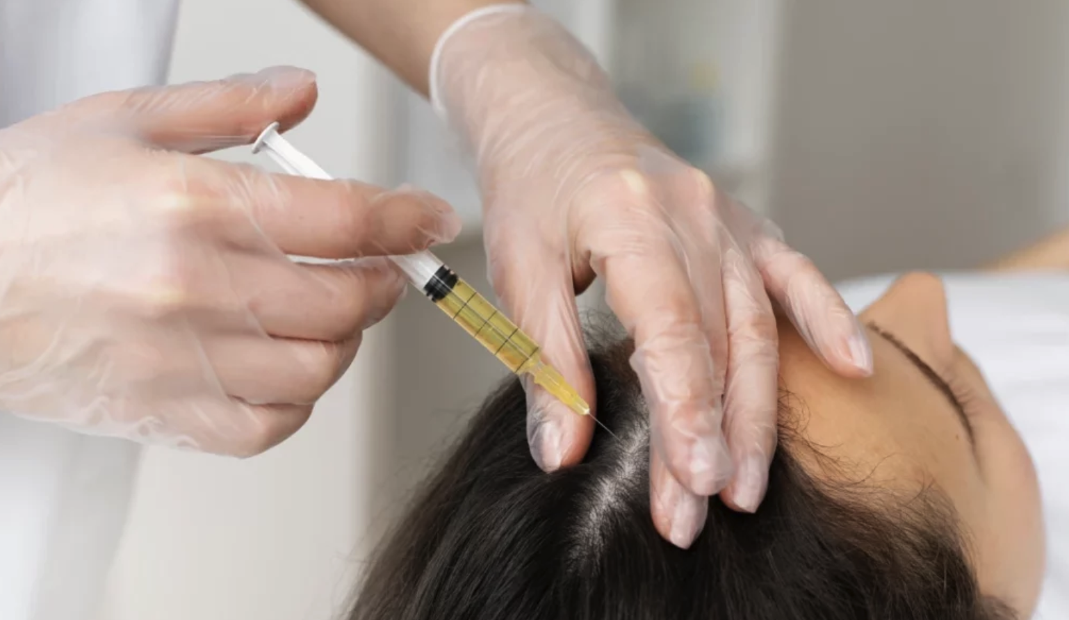 PRP Hair Restoration