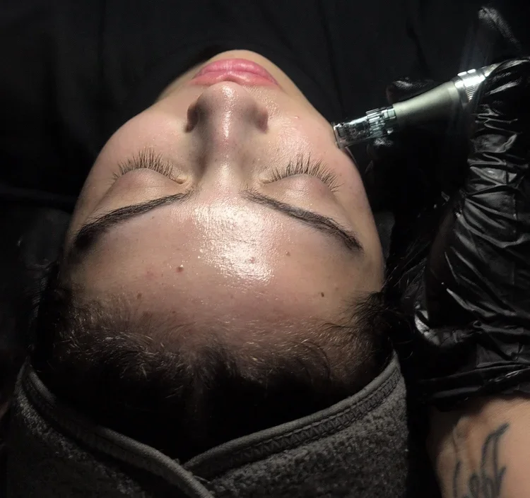 Microneedling+Treatment.webp
