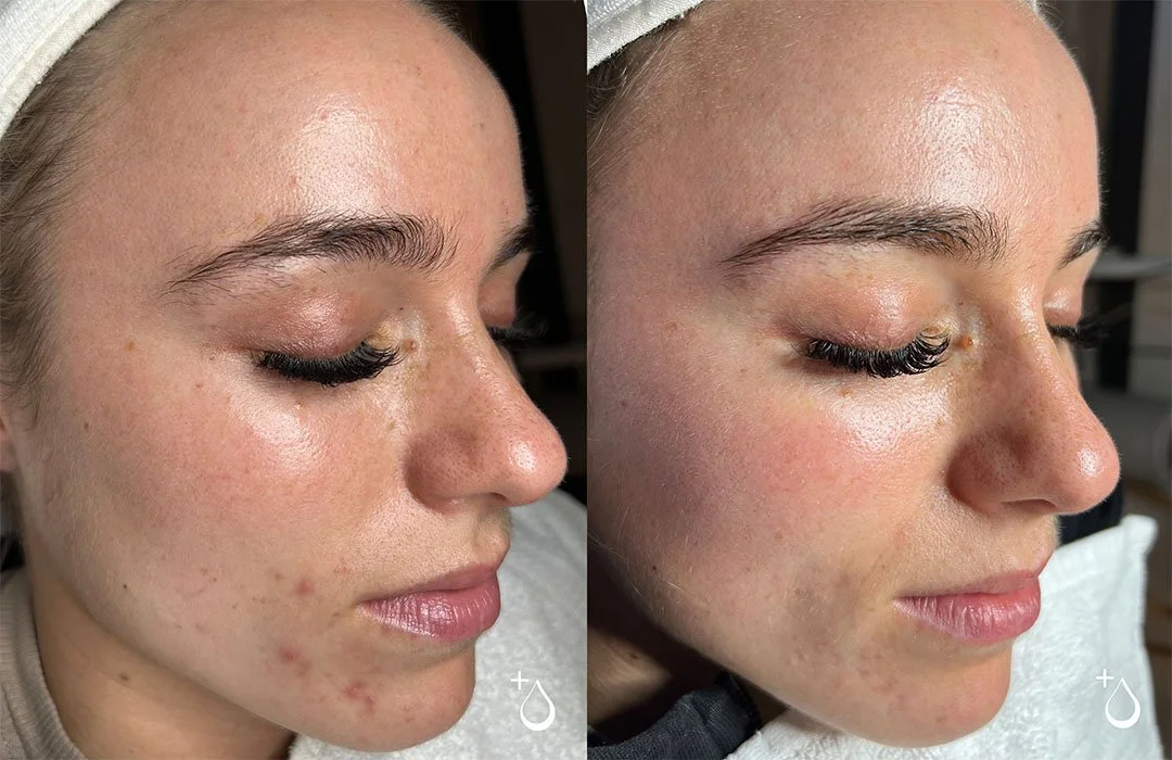 Acne Follow Up