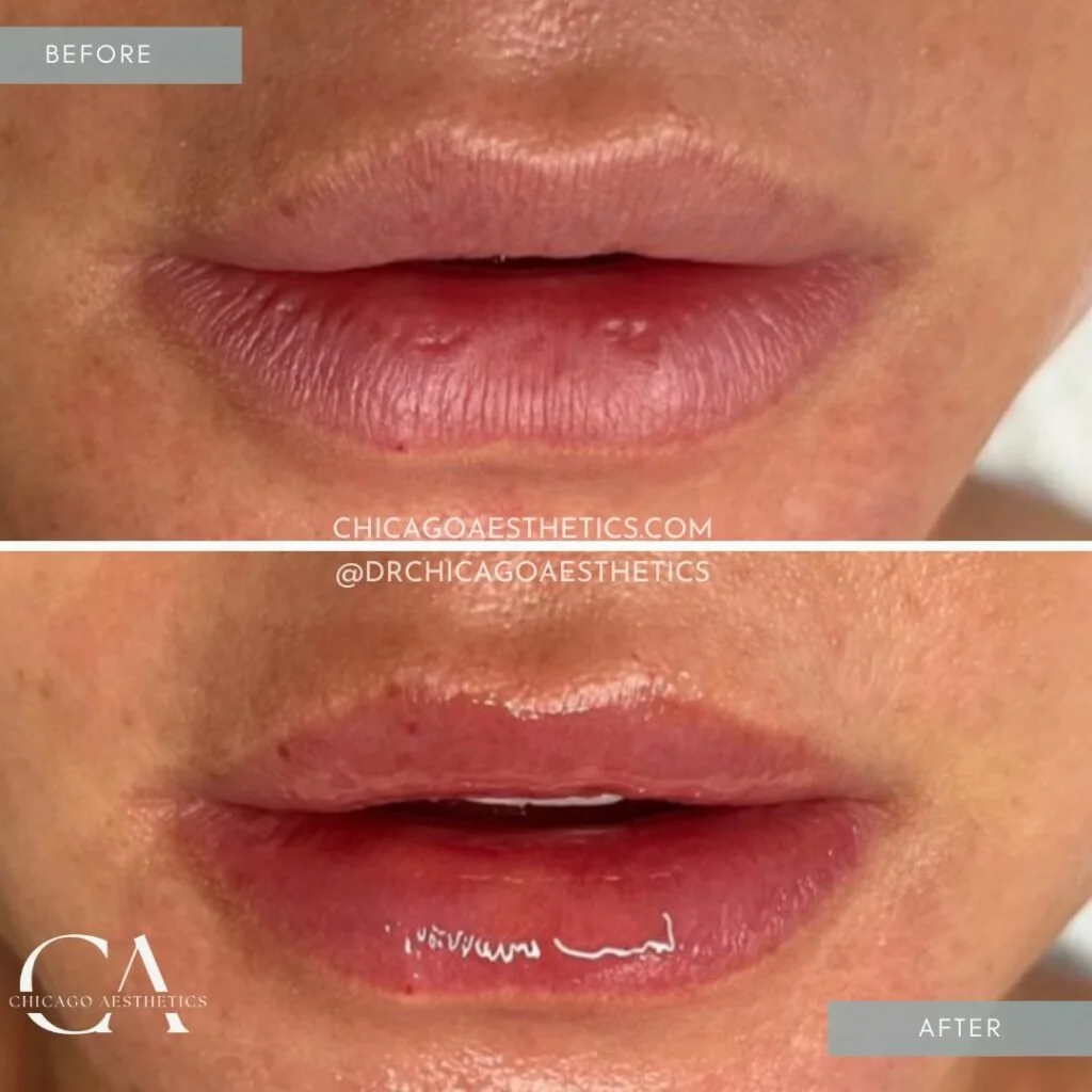 510-Hydrafacial-Lip-Perk-Before-After-Chicago-Aesthetics-1024x1024.jpg