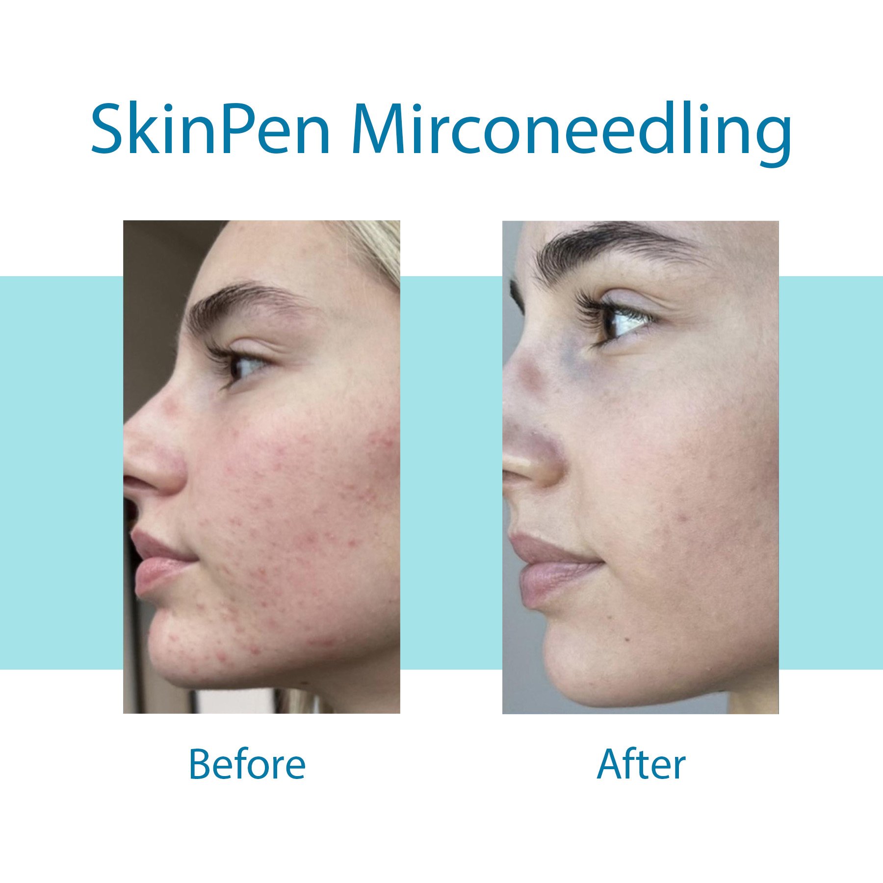 SkinPen-Microneedling-01.jpg