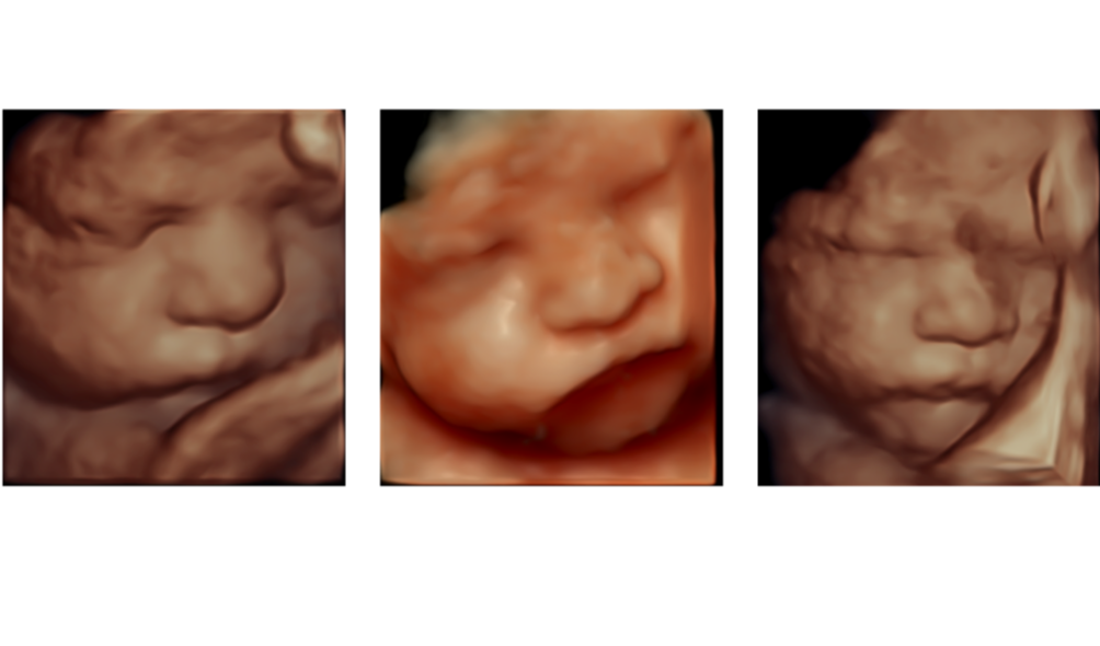 OBSTETRIC ULTRASOUND — Central West Women's Imaging