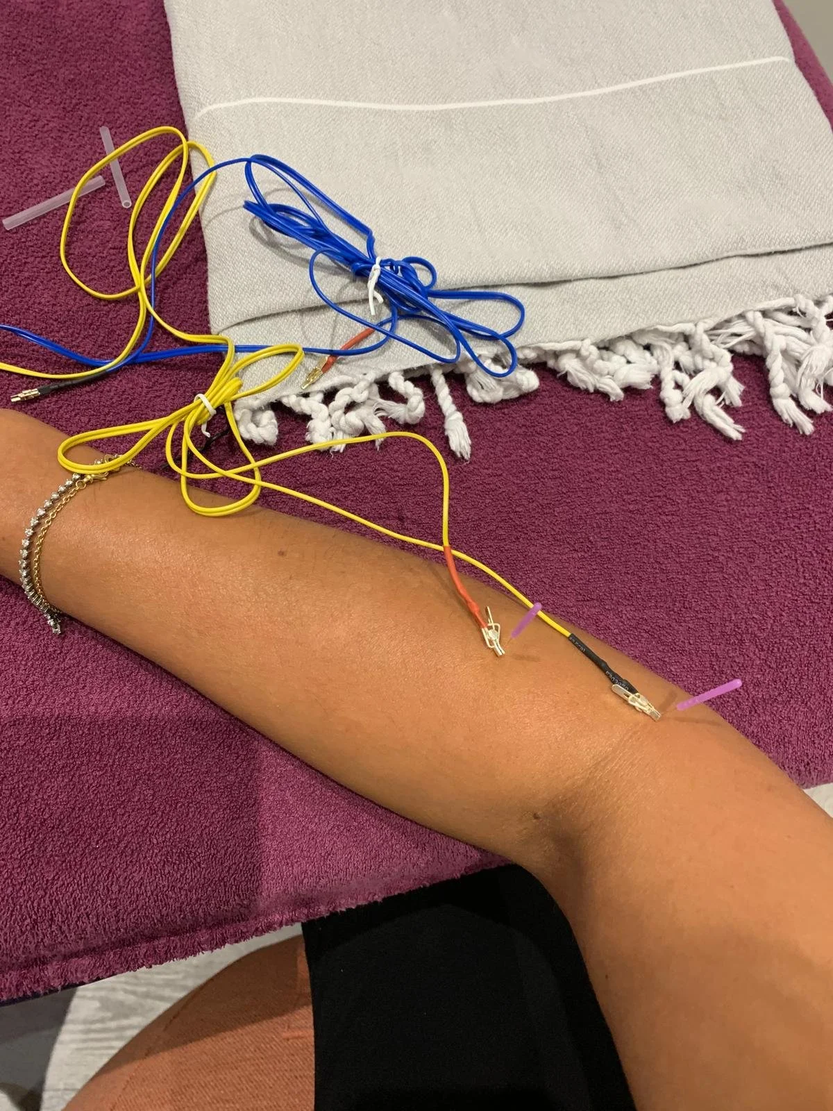 Person lying on a purple towel with arm extended, connected to medical wires and electrodes for a medical procedure.