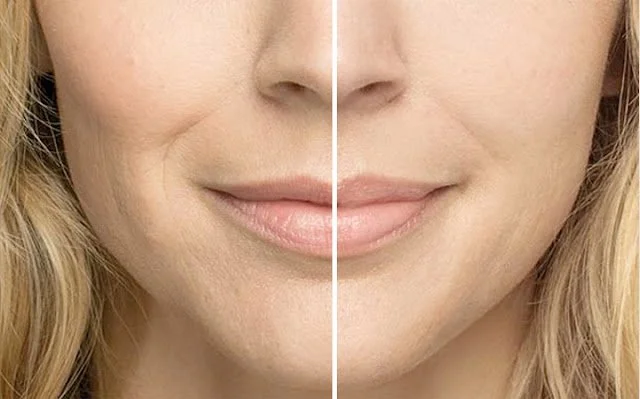 Belotero Treatments - Frequently Asked Questions