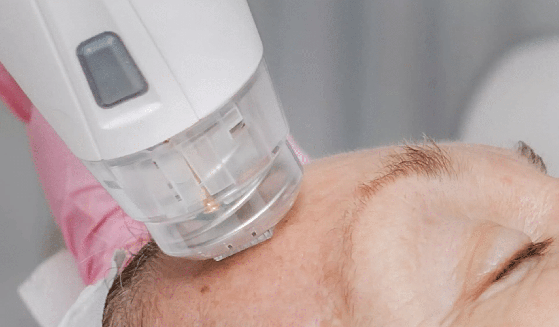 Rejuvenate Your Skin with Vivace Microneedling Laser: The Ultimate Guide
