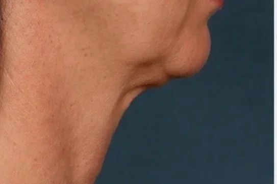 Kybella and Lymphatic Drainage