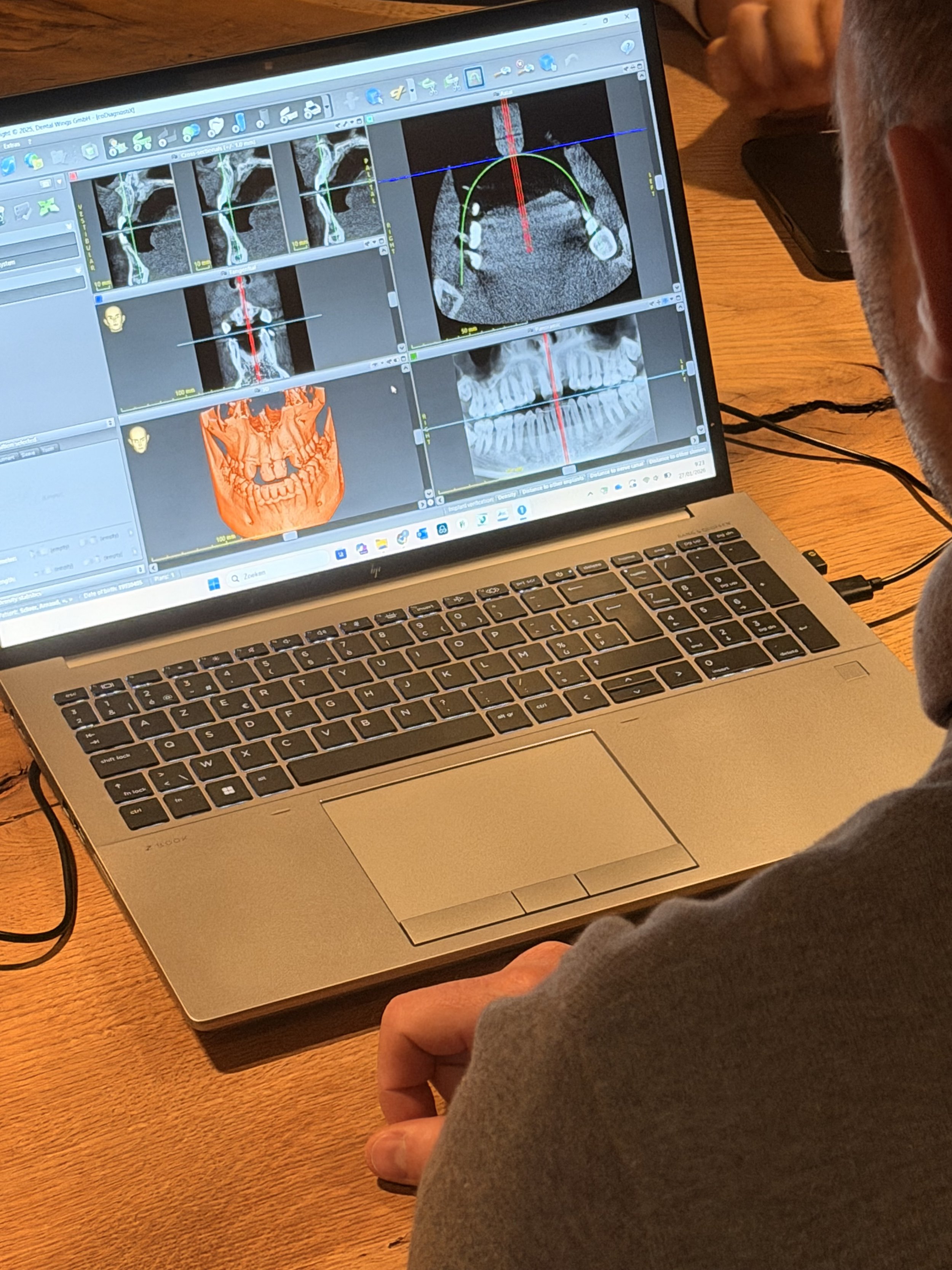 Planning van een behandeling met implantaten