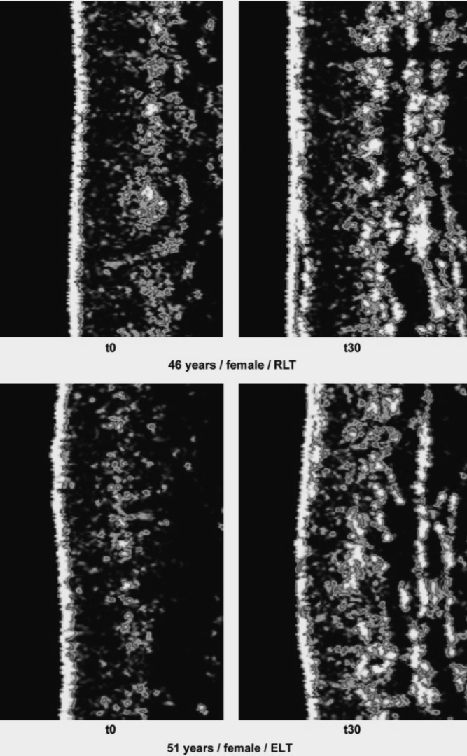Black and white scientific diagrams showing two sets of retinal images taken at different times (t0 and t30) from two women, one 46 years old and one 51 years old, illustrating retinal layer thickness changes over 30 days.