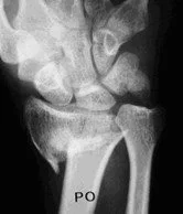 Colles Fractures