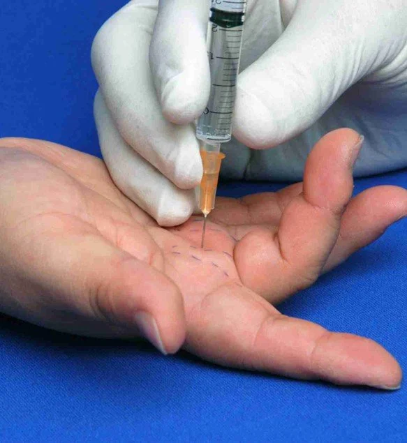 Cortisone Injections