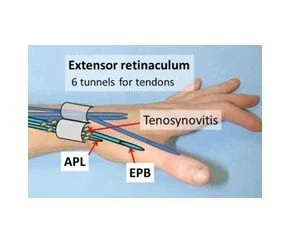 De Quervains Syndrome