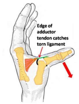Skiers Thumb Overview