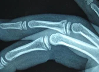Childrens Hand Fractures