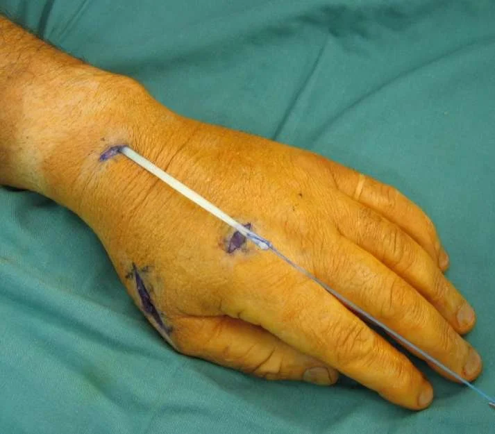 EI to EPL Tendon transfer