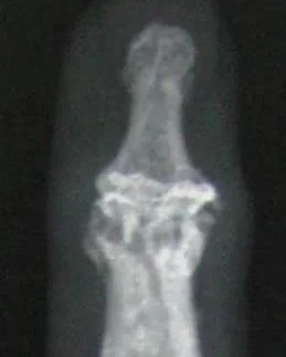 Osteoarthritis DIP joint