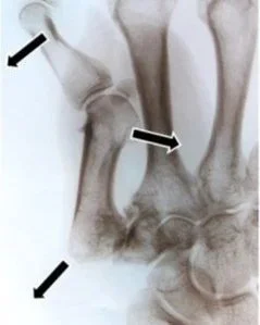 Osteoathritis Thumb CMC joint