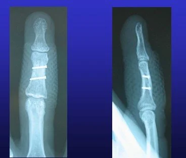 Finger Fracture Fixation