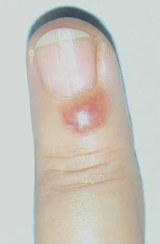 Mucous Cysts