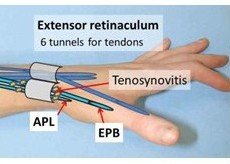 De Quervains Syndrome
