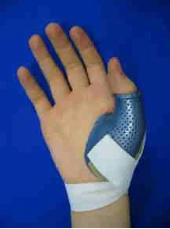 Skiers thumb Treatment