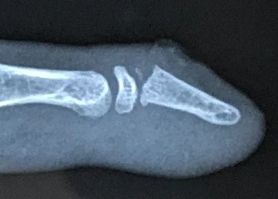 Seymour Fracture