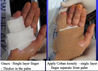 Dupuytrens Dressing Change