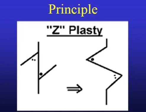 Dupuytrens - Z Plasty
