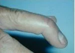 Mallet Finger