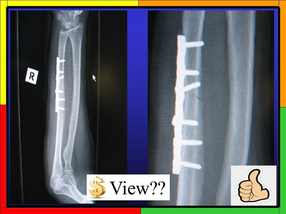 Ulnar Osteotomy Views