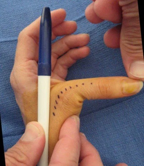 Skiers Thumb Diagnosis