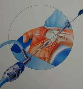 Endoscopic Carpal Tunnel Release