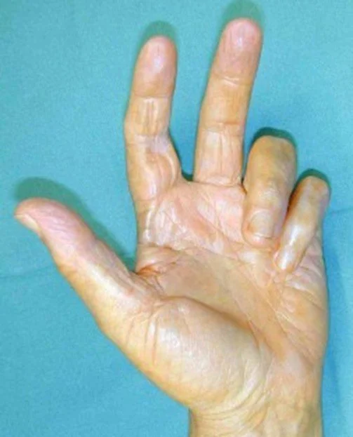 Dupuytrens - Fasciectomy