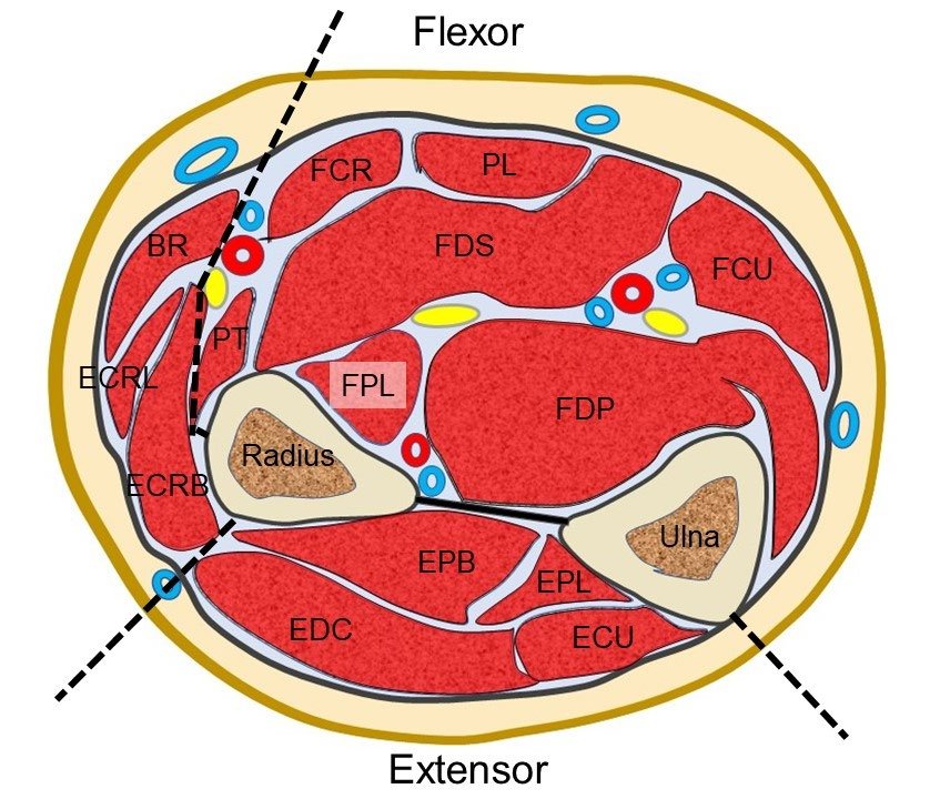 Chronic Forearm Compartment Syndrome