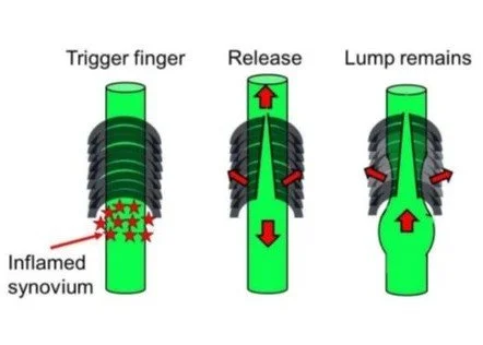 Trigger Finger Release