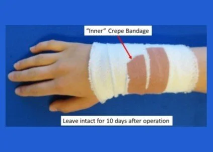 Dorsal Wrist Ganglion - Post op