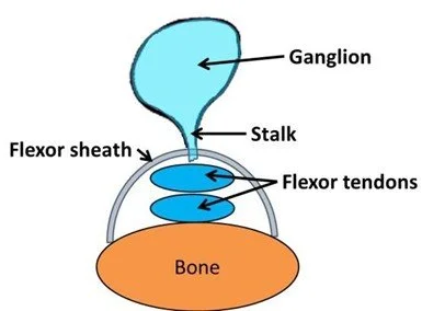 Flexor Sheath Ganglion