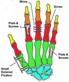 Hand Fractures