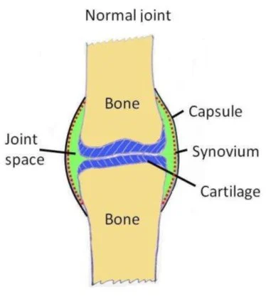 Osteoathritis v Inflammatory Arthritis